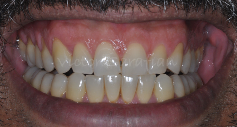 Photo du sourire initial qui montre l'importance du decouvrement et le sourire gingival