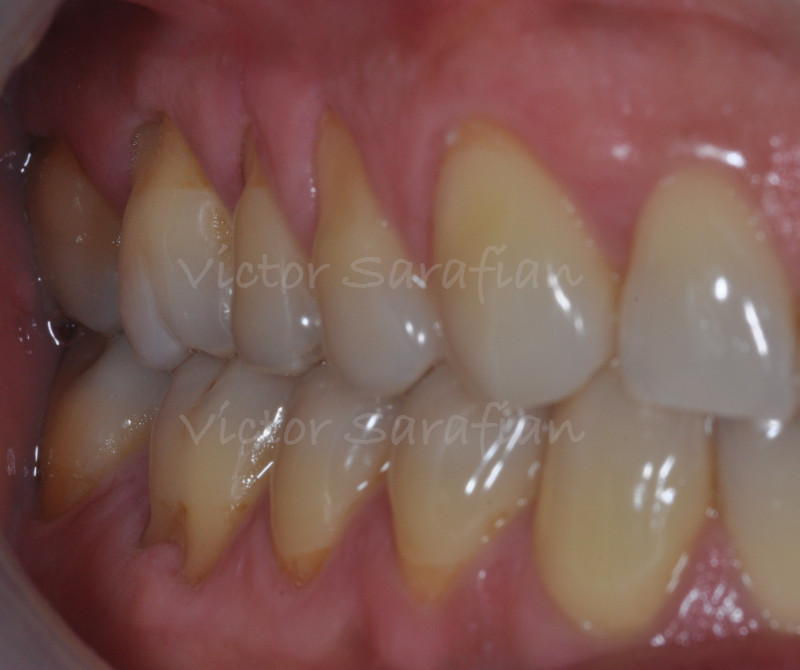 Vue latérale initiale des secteurs 1 et 4 qui montre les récessions gingivales