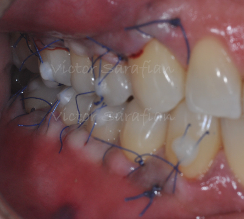Vue post chirurgicale des secteurs 1 et 4 qui montre les lambeaux positionnés sur les récessions grace aux sutures