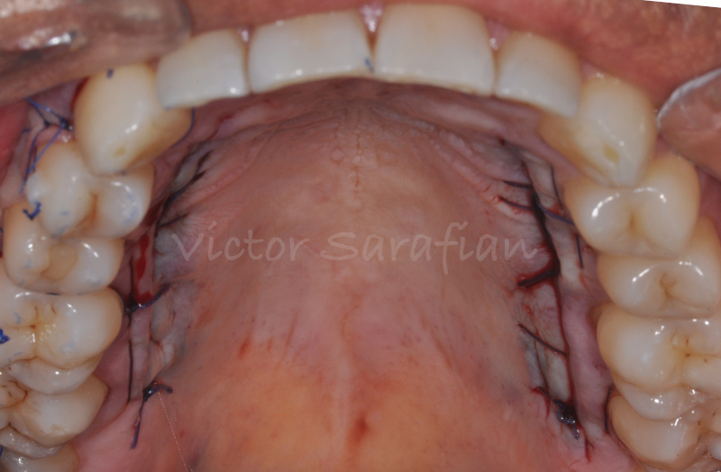 Vue du palais après prélèvements bilatéraux selon la technique de Bruno ; sutures selon la technique de Borghetti