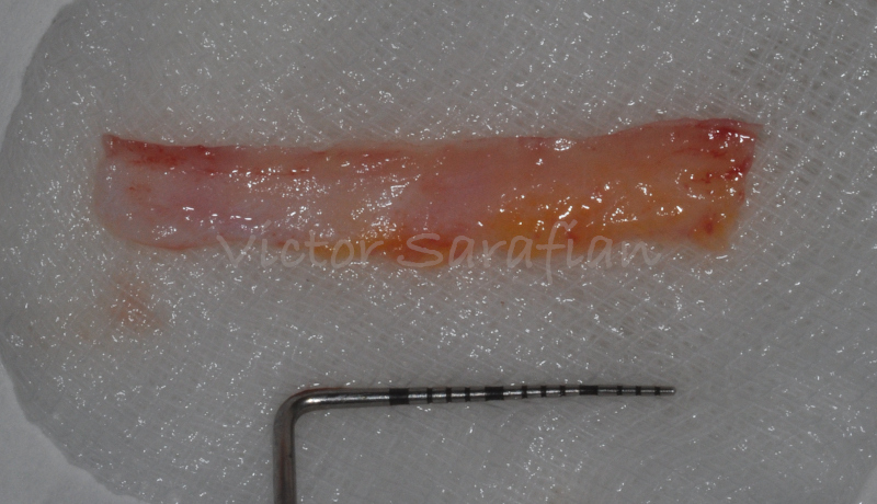 Greffon conjonctif après prélèvement