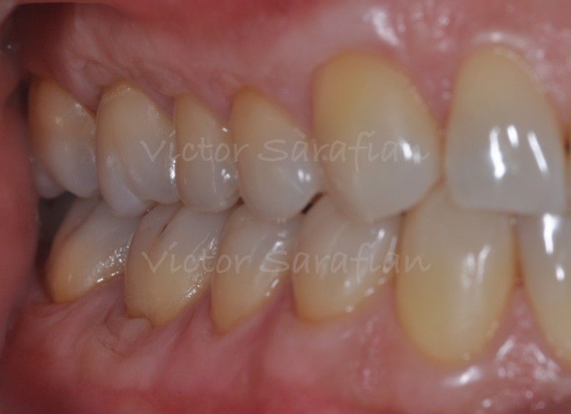 Vue des secteurs 1 et 4 après 16 mois de cicatrisation