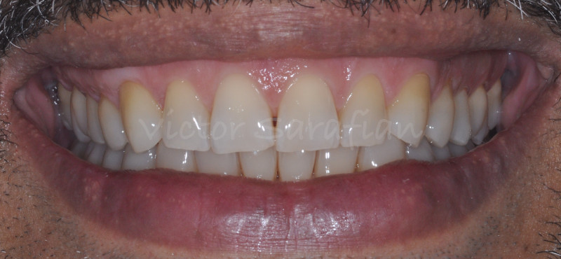 Photo du sourire final qui montre le recouvrement radiculaire et l'esthetique retrouvee du sourire