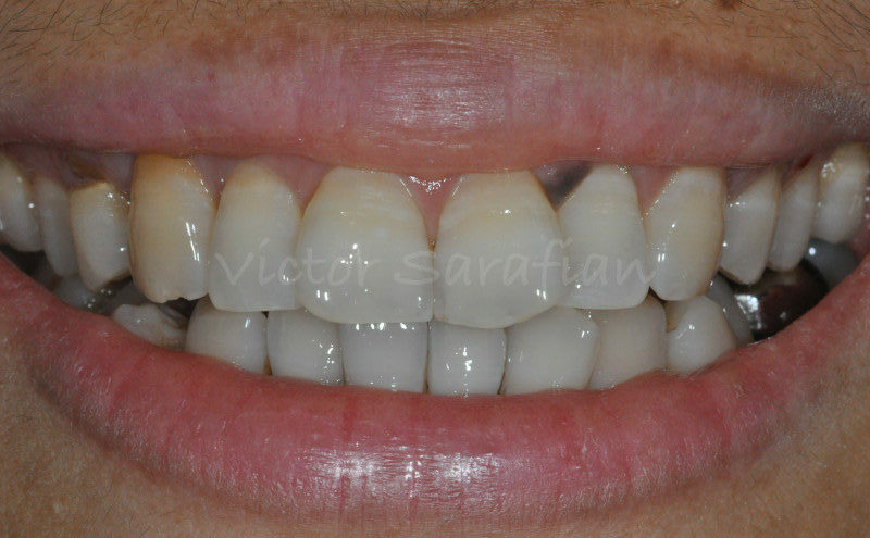 Sourire initial de la patiente avec exposition de la lésion pigmentée