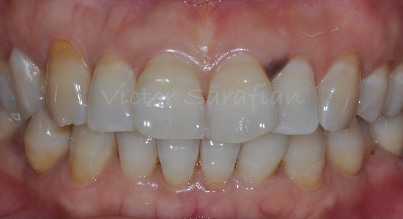 Vue endobuccal mettant en evidence le parodonte marginal et la lésion pigmentée