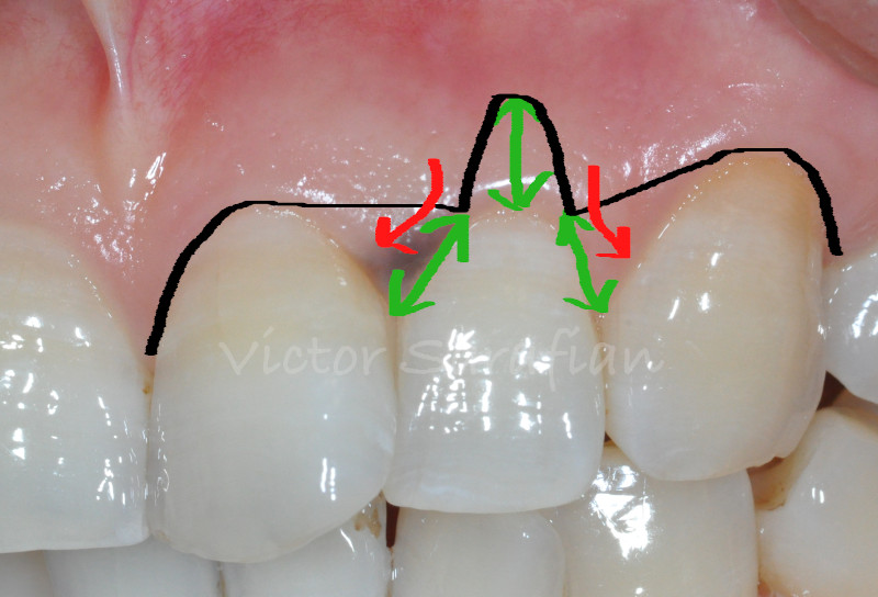 Schéma du tracé d'incision du lambeau déplacé coronairement. La récession artificielle est située sur la dent #22 et les papilles chirurgicale en mésial et en distal seront déplacé sur les papilles anatomiques correspondantes