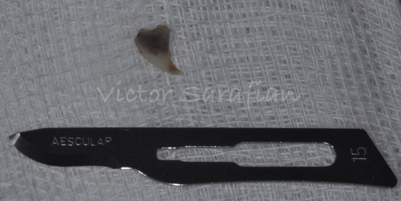 biopsie de la lesion pigmentée d'environ 4-5mm en regard d'une lame de bistouri 15