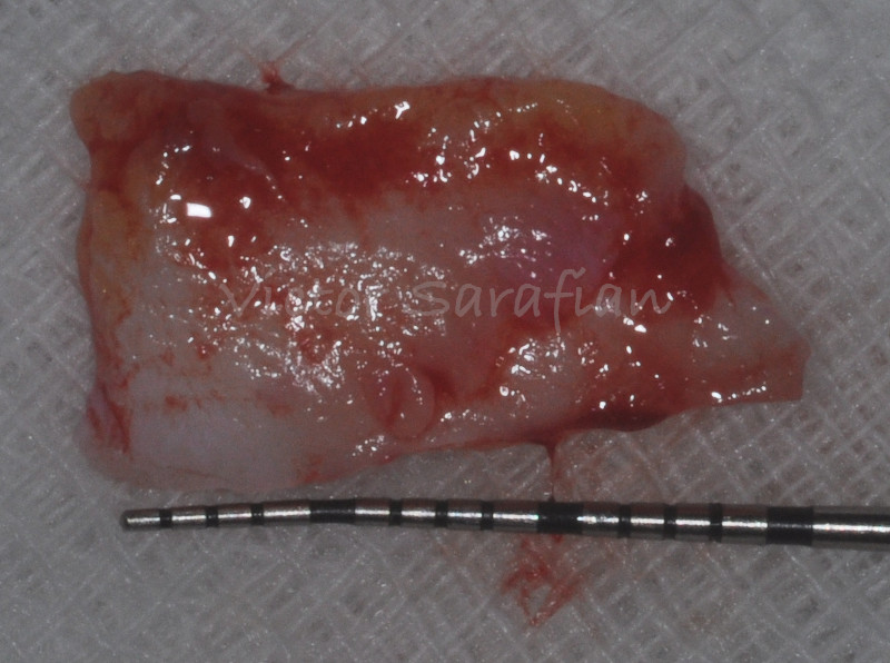 greffon conjonctif prélevé au palais d'environ 15mm de long par 8mm de large