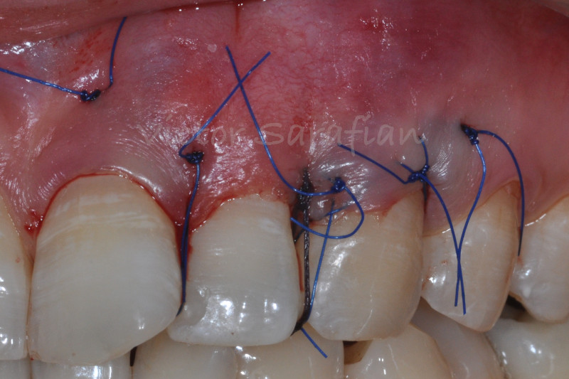 photo post operatoire qui montre le lambeau positionne coronairement stabilise a l'aide des sutures autours des plots de composites interdentaire. Le greffon est lui stabilisé à l'intérieur du lambeau en mésial et en distal.