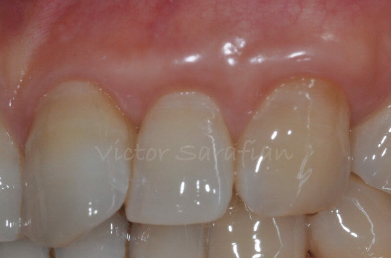 Papille distale de #22 saine et de couleur rose après plus de 4,5 années post greffe gingivale