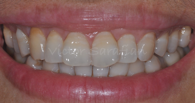 Sourire de la patiente qui montre une gencive marginale rose et en bonne santé avec des papilles rose et saine